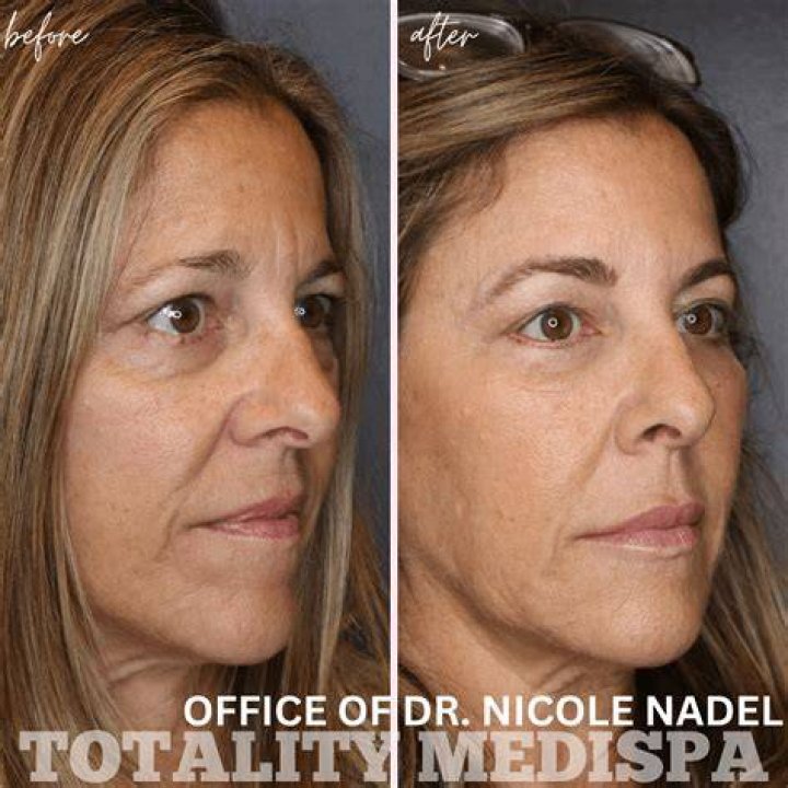 Before and After Medispa Visit Here For It All blog