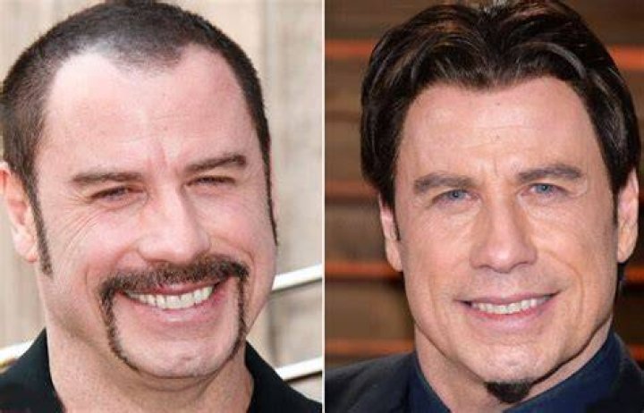 John Travolta Plastic Surgery Facelift, Botox, Hair transplant